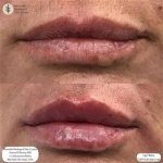 When Beauty Goes Wrong: Understanding Botched Fillers